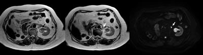 Case report: Stereotactic MR-guided adaptive radiotherapy for inoperable urothelial carcinoma at the renal pelvis